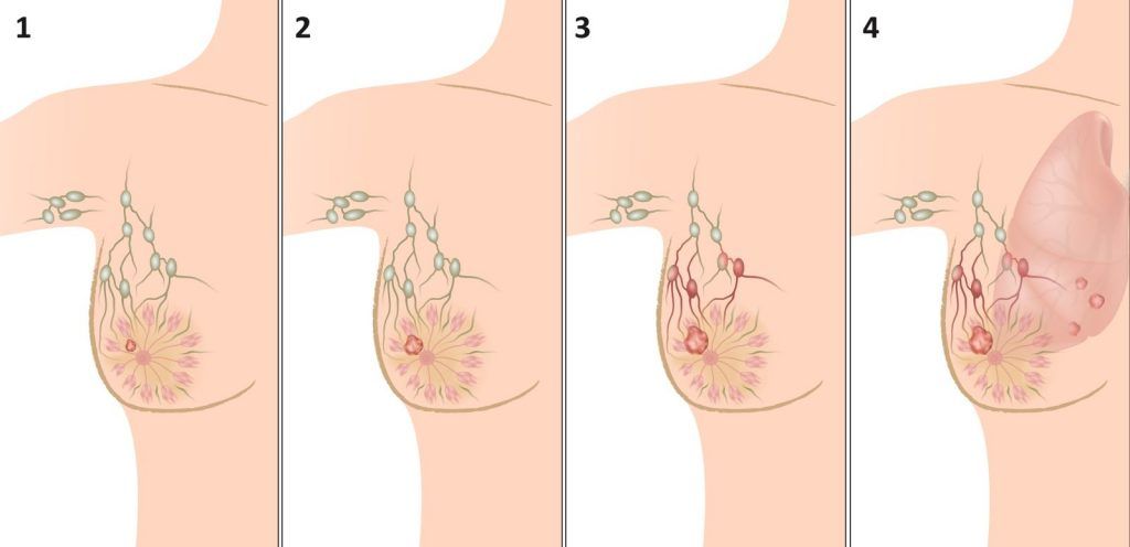 лечение рака груди 4 стадии