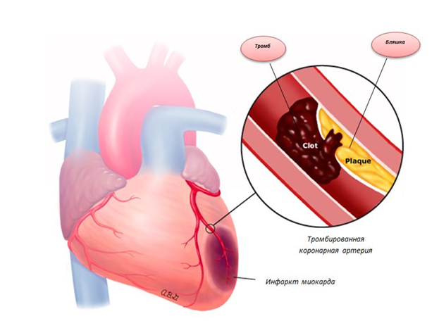 лечение атеросклероза сосудов сердца