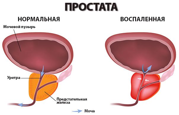 enterococcus faecalis in prostate)