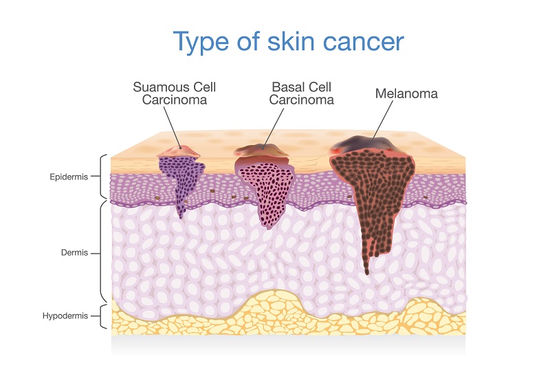 виды рака кожи
