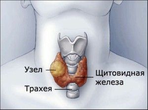 лечение узлов щитовидной железы