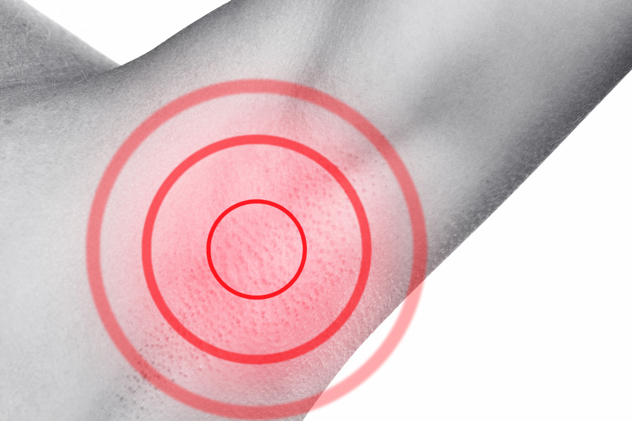 Биопсия сторожевого лимфоузла при меланоме