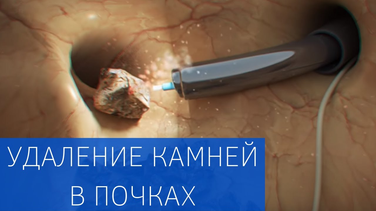 Мочекаменная болезнь: удаление камней и лечение почечной колики 