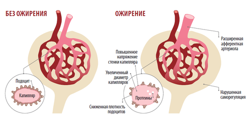Ожирение бьет по почкам