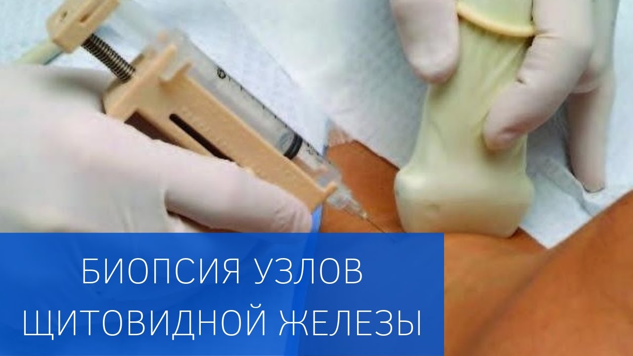 Пункционная биопсия узлов щитовидной железы в ЕМС 