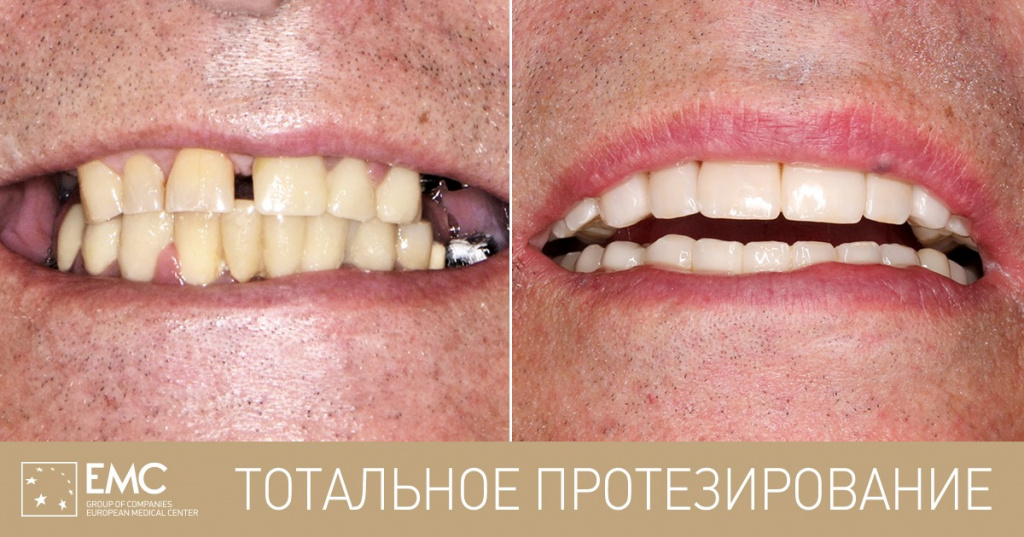 тотальное протезирование зубов