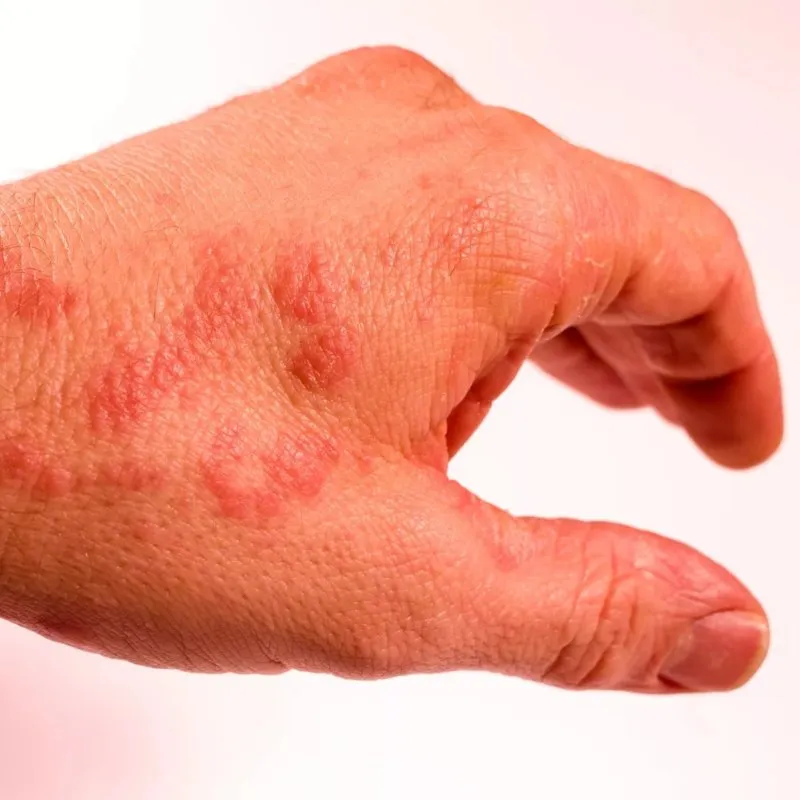 Аллергии и атопический дерматит - одна из причин это жесткая вода